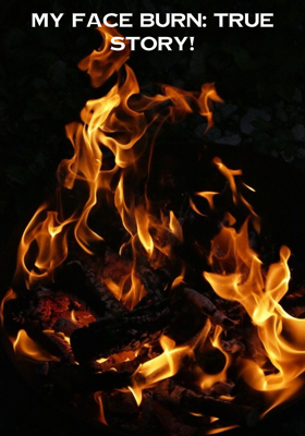 My face burn: True story!