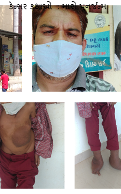 કેન્સર કથાઓ : મારો પુનર્જન્મ