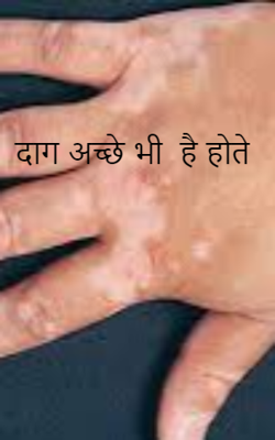 दाग अच्छे भी हैं होते