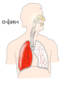 ઇન્ફેક્શન