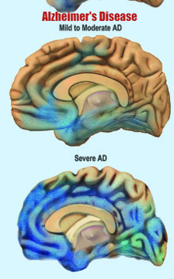 Alzheimer's Disease