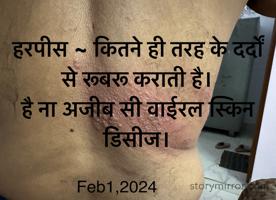 हरपीस ~ कितने ही तरह के दर्दों से रूबरू कराती है।
है ना अजीब सी वाईरल स्किन डिसीज।
